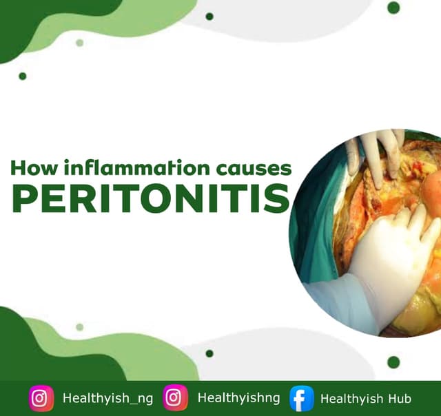 PREVENTING PERITONITIS, AN INFLAMMATORY DISEASE