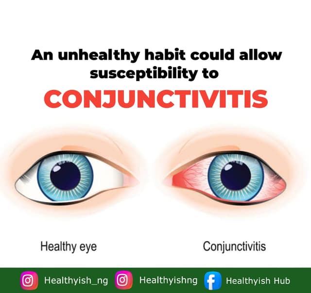 PREVENTING CONJUCTIVITIS; AN INFLAMMATORY DISEASE