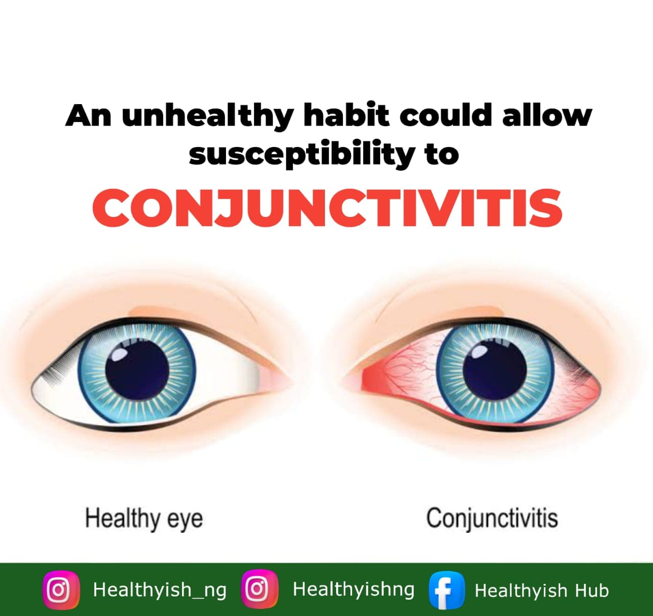 PREVENTING CONJUCTIVITIS; AN INFLAMMATORY DISEASE